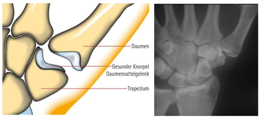 Gesundes Daumensattelgelenk – Anatomie und Röntgenbild